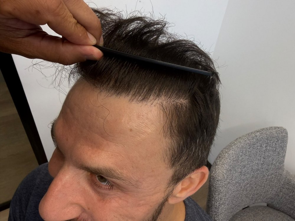 5. Hairline result - Left.jpeg