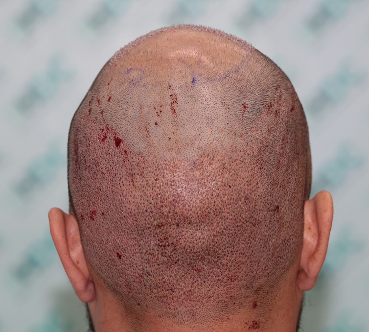 5.  Post op Back 5000 grafts.JPG