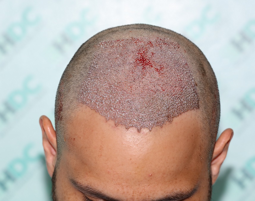 5. Post op Front 3520 Grafts on 24-06-20.JPG