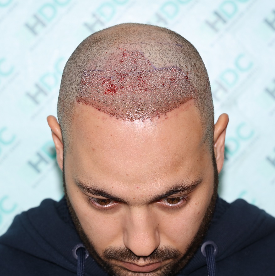 5. Post op FUE1 Recipient for 2660 Grafts- Front.JPG
