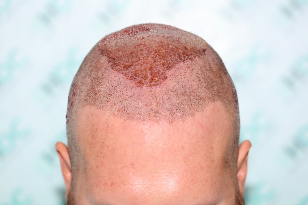 5. Post op FUE2 for 4050 grafts - Front.JPG
