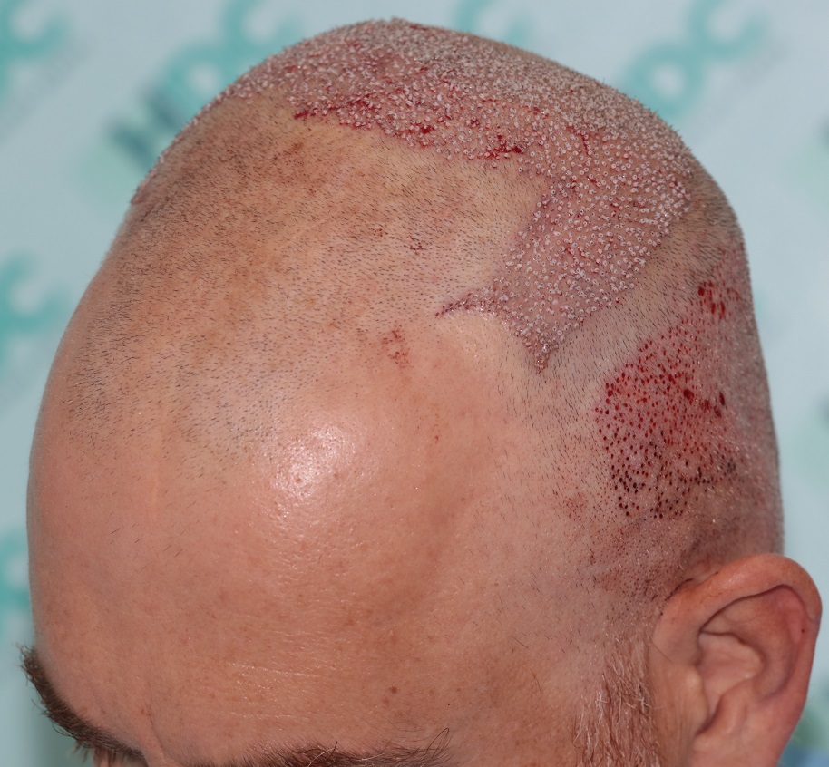 5. Post op Left.JPG