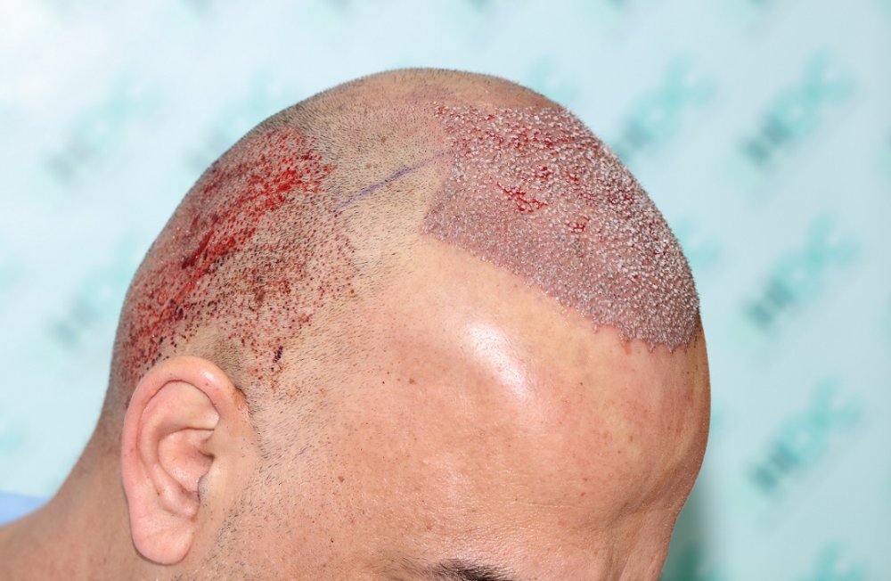 5. Post op -  left top.JPG