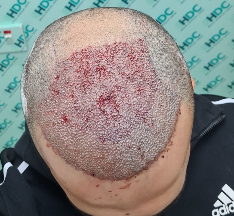5. post op1 for 4350 grafts.jpg
