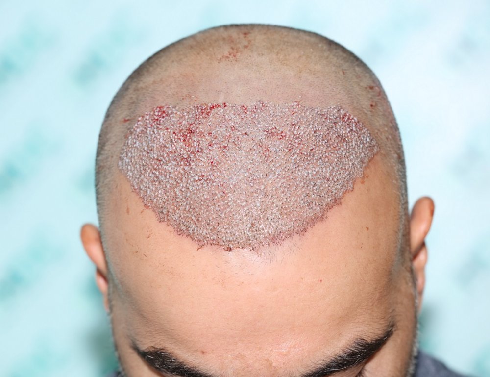 5. Recipient post op.JPG