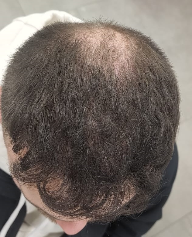 5. Result of FUE1.jpg