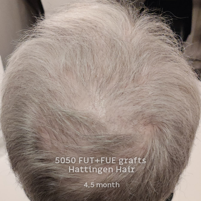 5050-fut-fue-hattingenhair-4andhalf-months-back.jpg