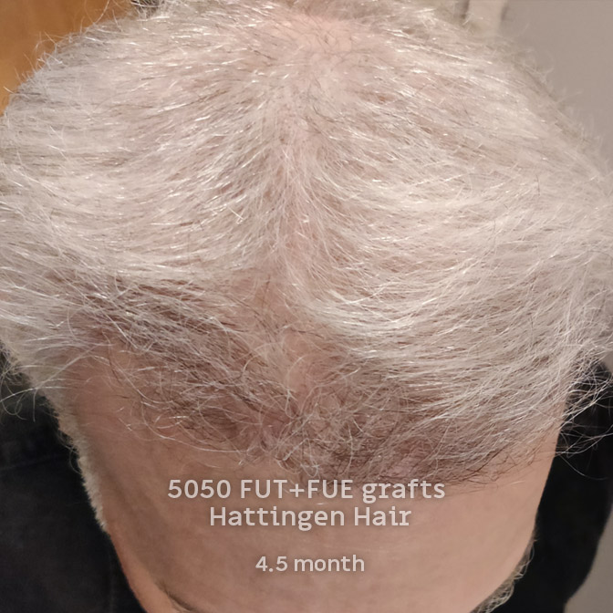 5050-fut-fue-hattingenhair-4andhalf-months-front.jpg