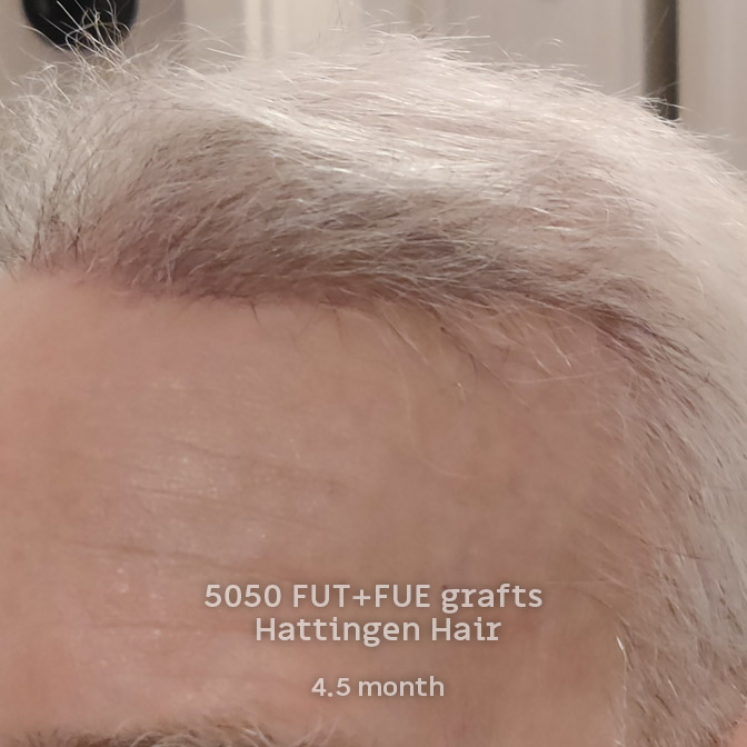 5050-fut-fue-hattingenhair-4andhalf-months-frontside.jpg
