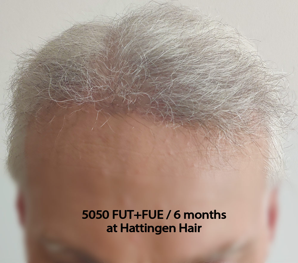 5050grafts-hattingenhair-6month-front.jpg