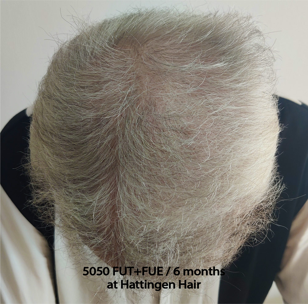 5050grafts-hattingenhair-6months-above.jpg