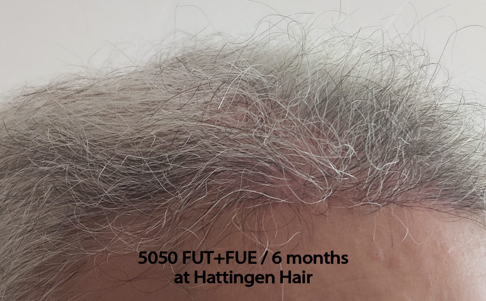 5050grafts-hattingenhair-6months-closeup.jpg