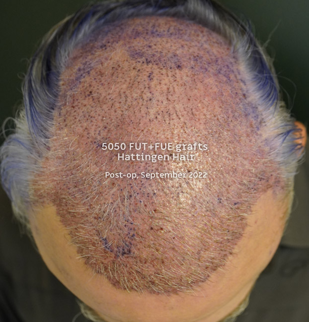5050grafts-hattingenhair-postop-from-above (1).jpg