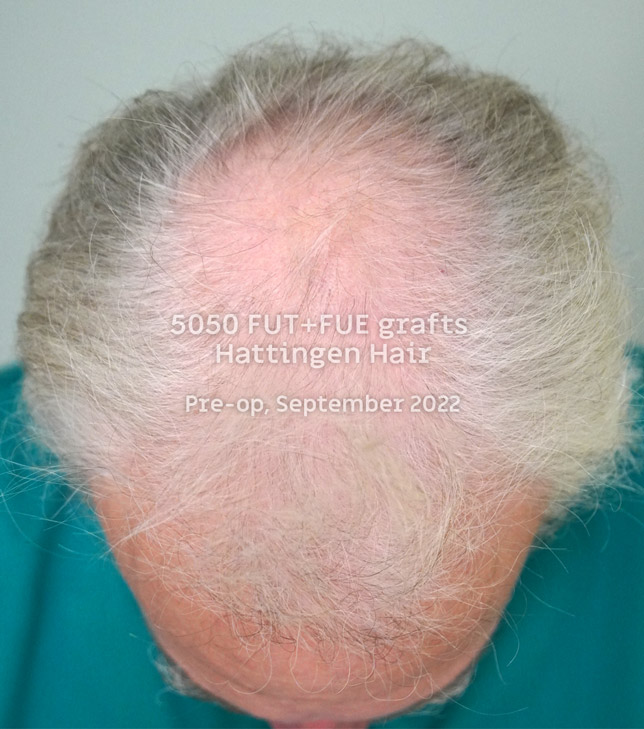 5050grafts-hattingenhair-postop-from-above.jpg