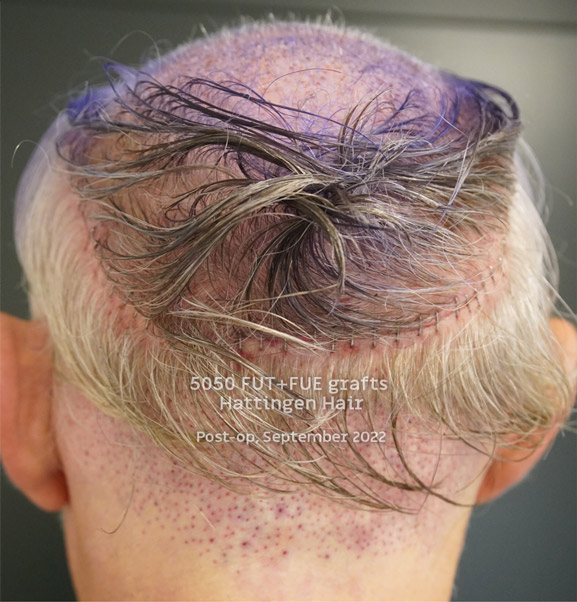 5050grafts-hattingenhair-postop-from-behind (1).jpg
