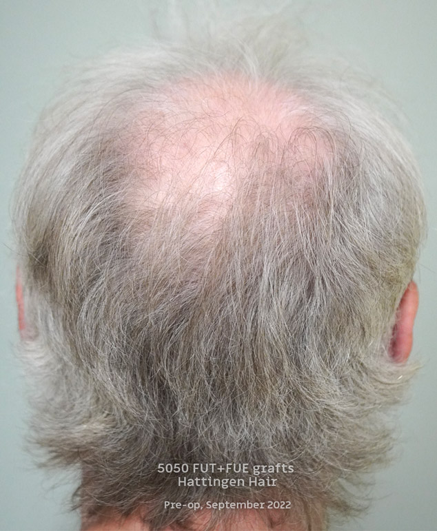 5050grafts-hattingenhair-postop-from-behind.jpg