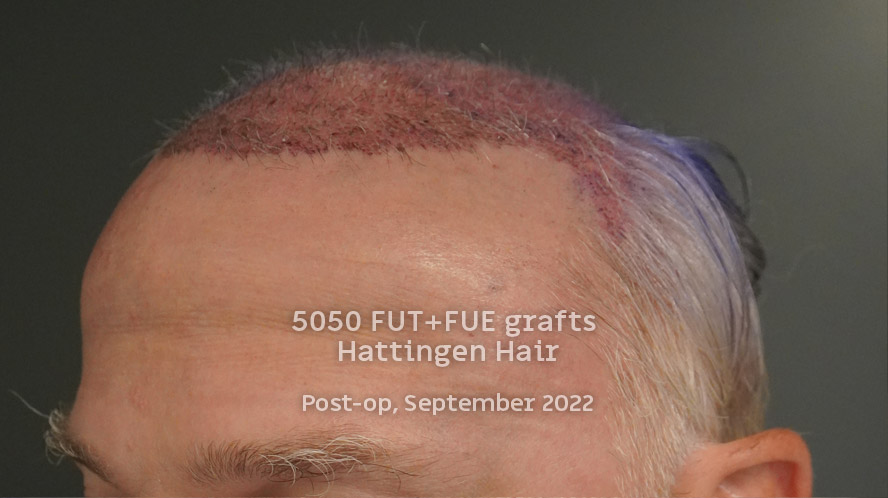 5050grafts-hattingenhair-postop-from-front.jpg