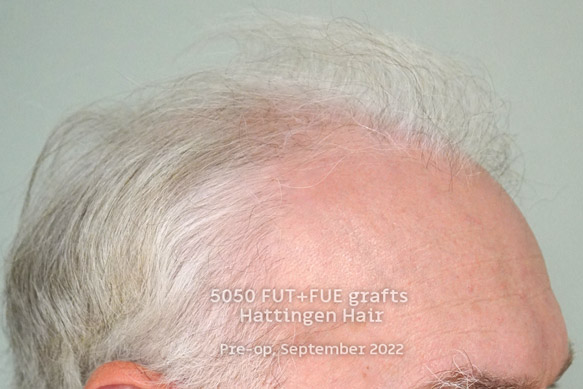 5050grafts-hattingenhair-postop-from-side.jpg