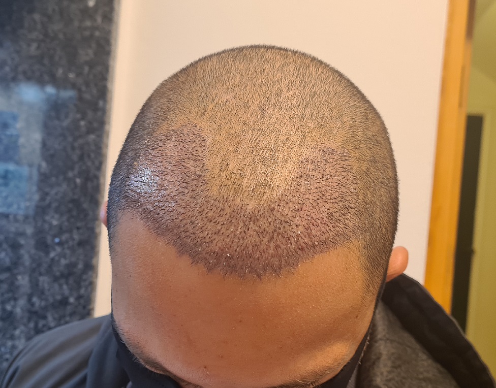 6 -1 week after.jpg