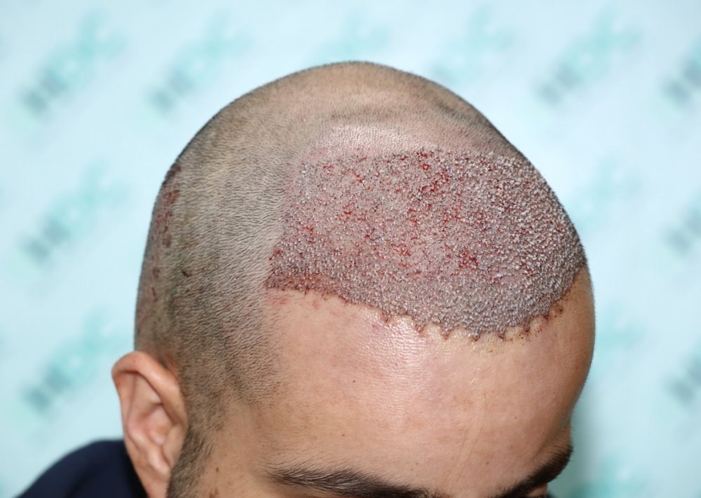6. 3200 Grafts post op - Right Top.JPG