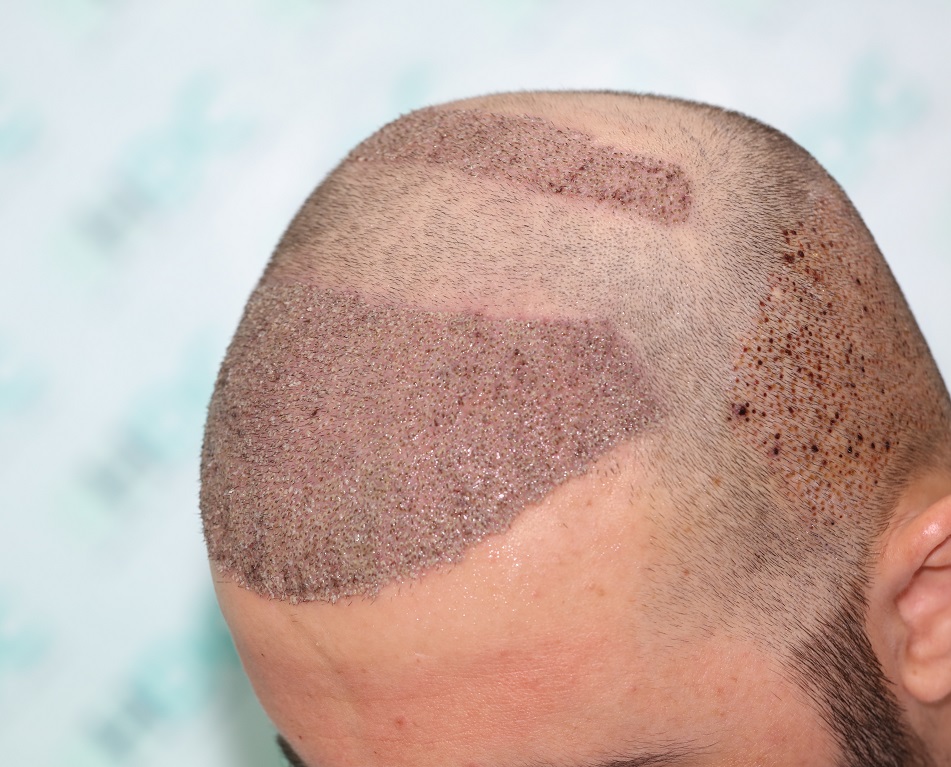 6. 4180 grafts post op.JPG