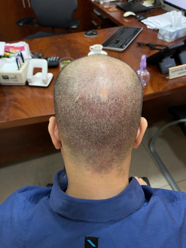 6. 5 days after Back donor.jpg