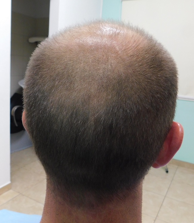 6. Before back donor.JPG