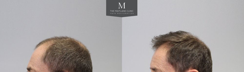 6-Before_After_Left.jpg