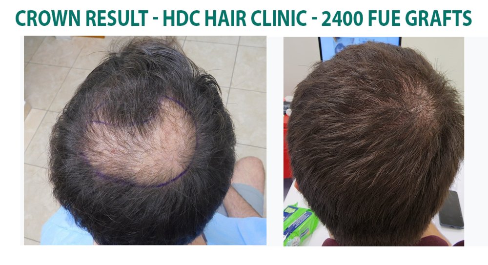 6. Crown result 2400 grafts.jpg