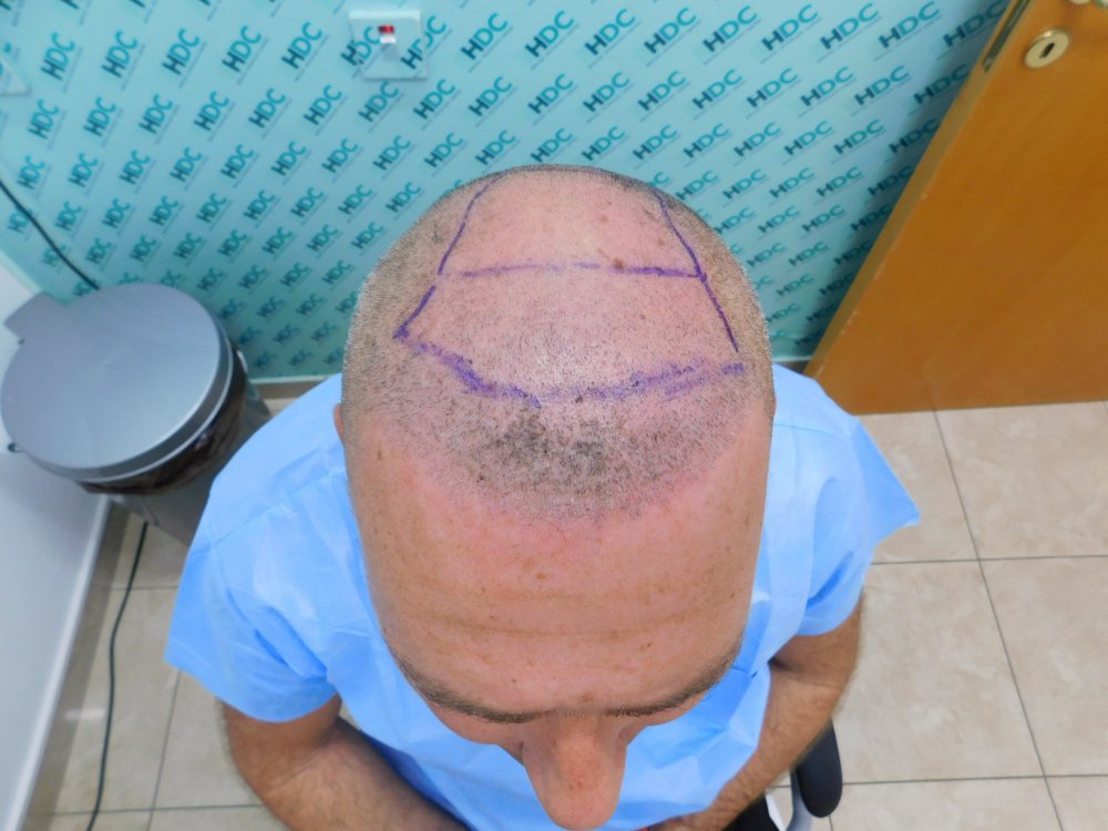 6. Design FUE2 Top Front.JPG