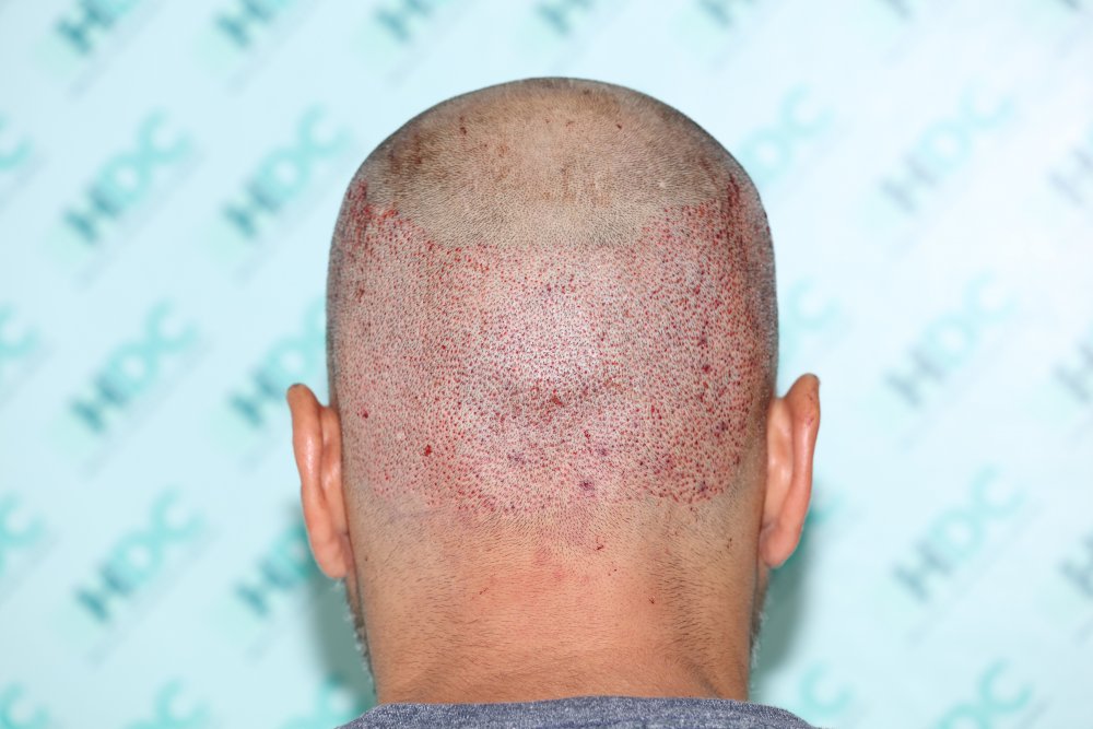 6. Donor post op.JPG