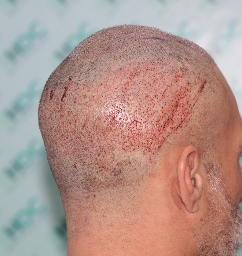 6. donor post op.JPG