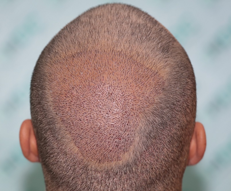 6 FUE2 - post op - 2932 Grafts on 23-03-22.JPG