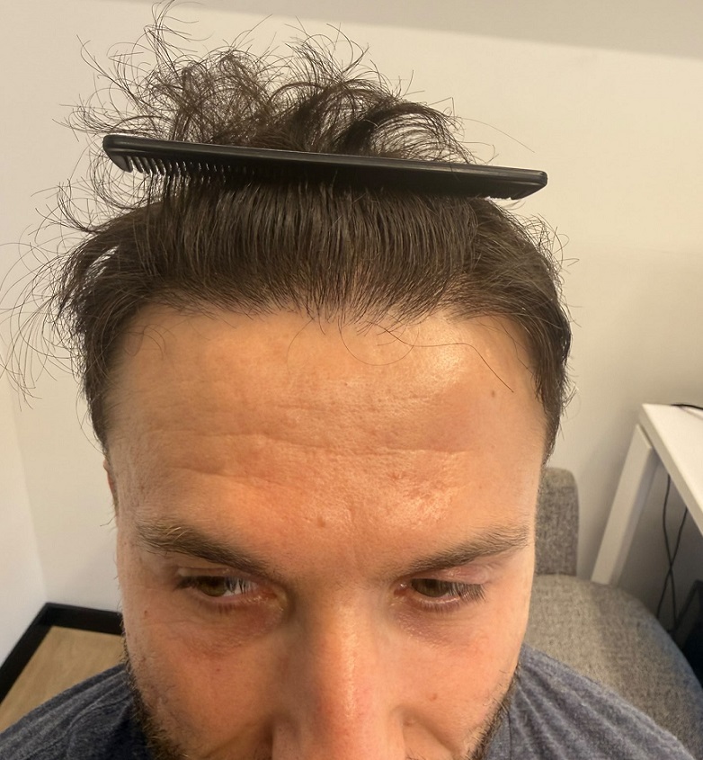 6. Hairline result - Front.jpeg