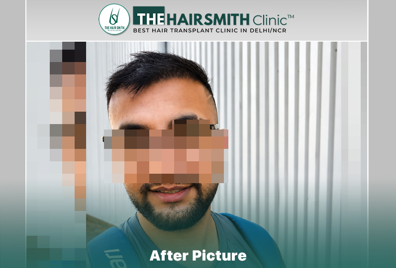 6 months hairsmith hair transplant result - the hairsmith clinic delhi #hairtransplant.jpg