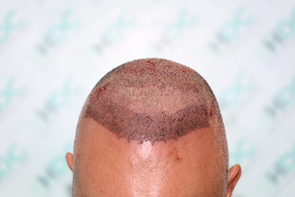 6 Post op front FUE2.JPG