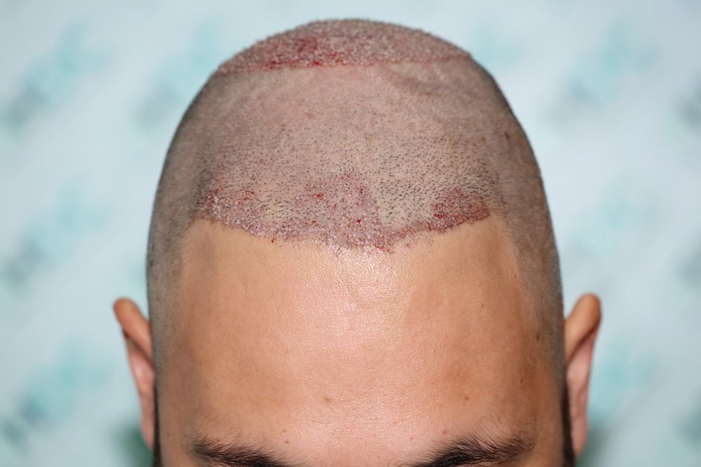 6. Post op FUE2 Recipient for 340 Grafts- Front.JPG