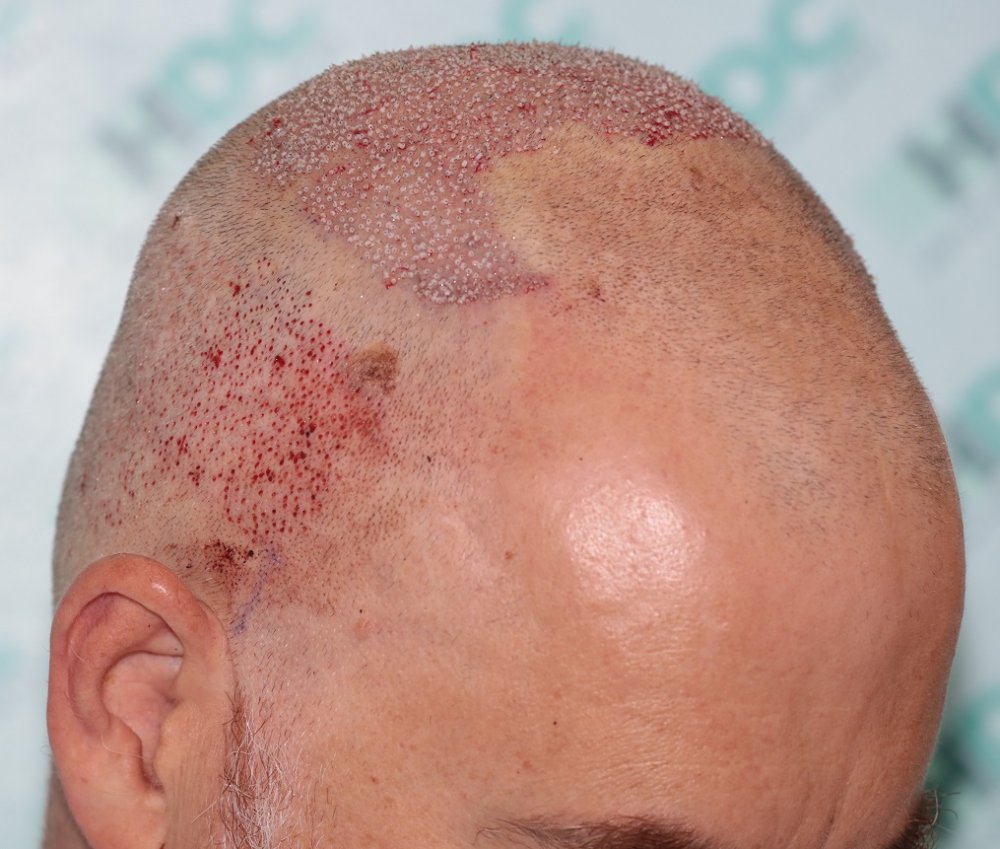 6. post op right.JPG