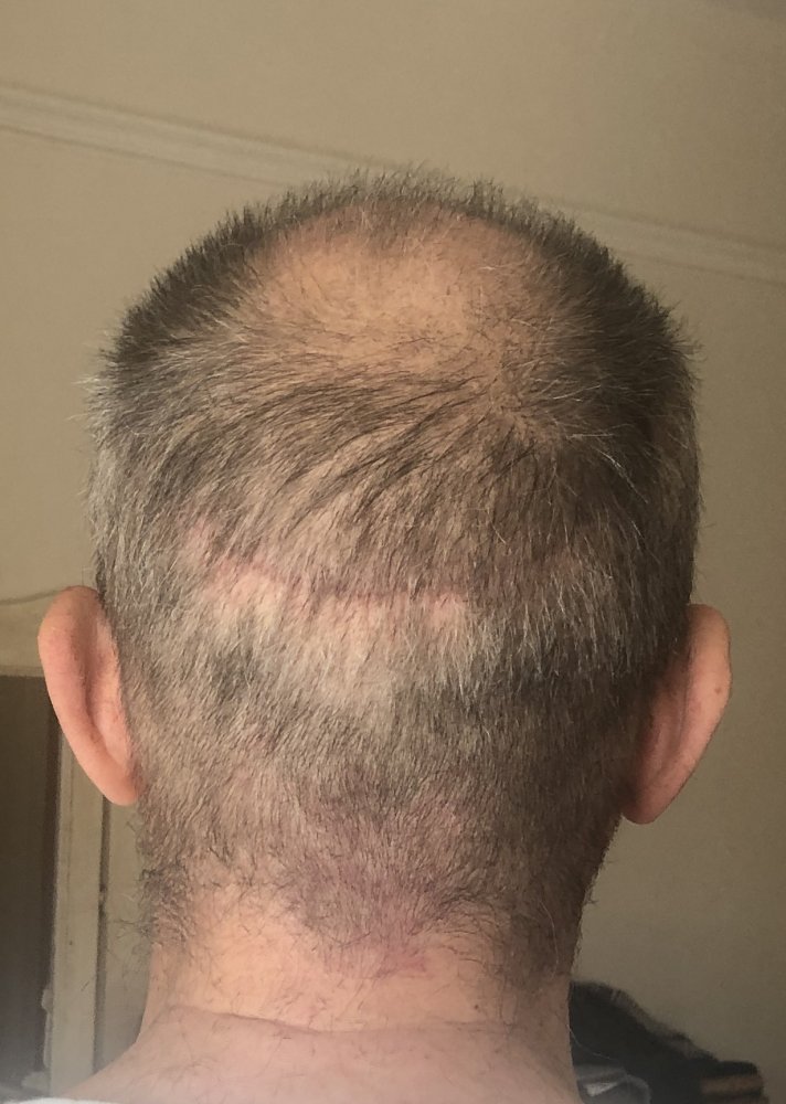 6 weeks post #1.JPG