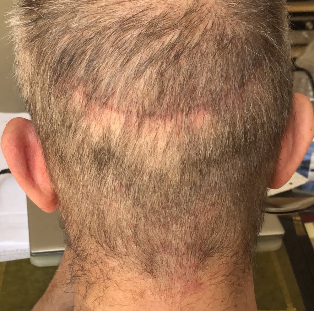 6 weeks post #2.JPG