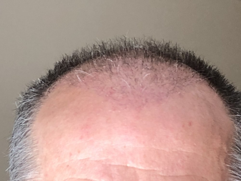 6 weeks post 2768.JPG