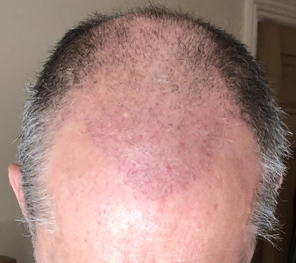 6 weeks post 2776.JPG