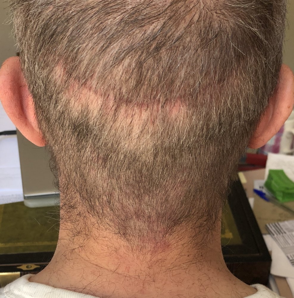 6 weeks post #3.JPG