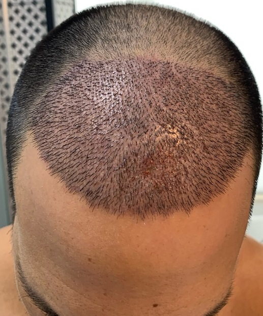 7. 8 days after surgery.jpg