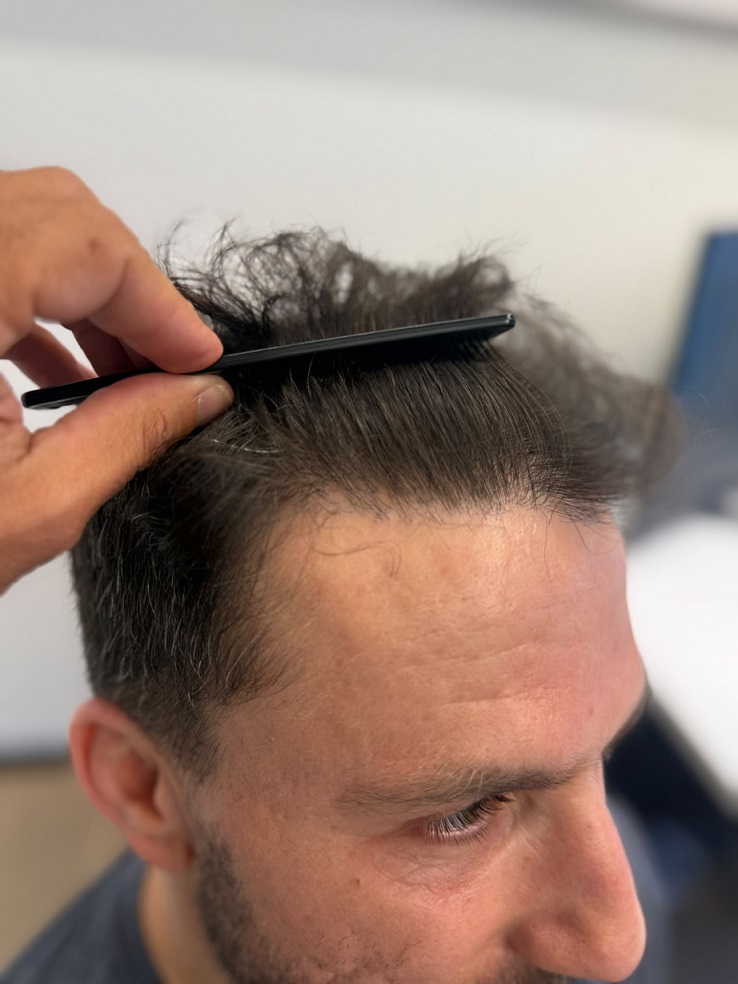 7. Hairline result - Right.jpeg
