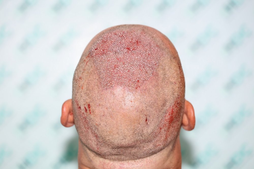 7. Post op 2515 grafts for FUE2.JPG