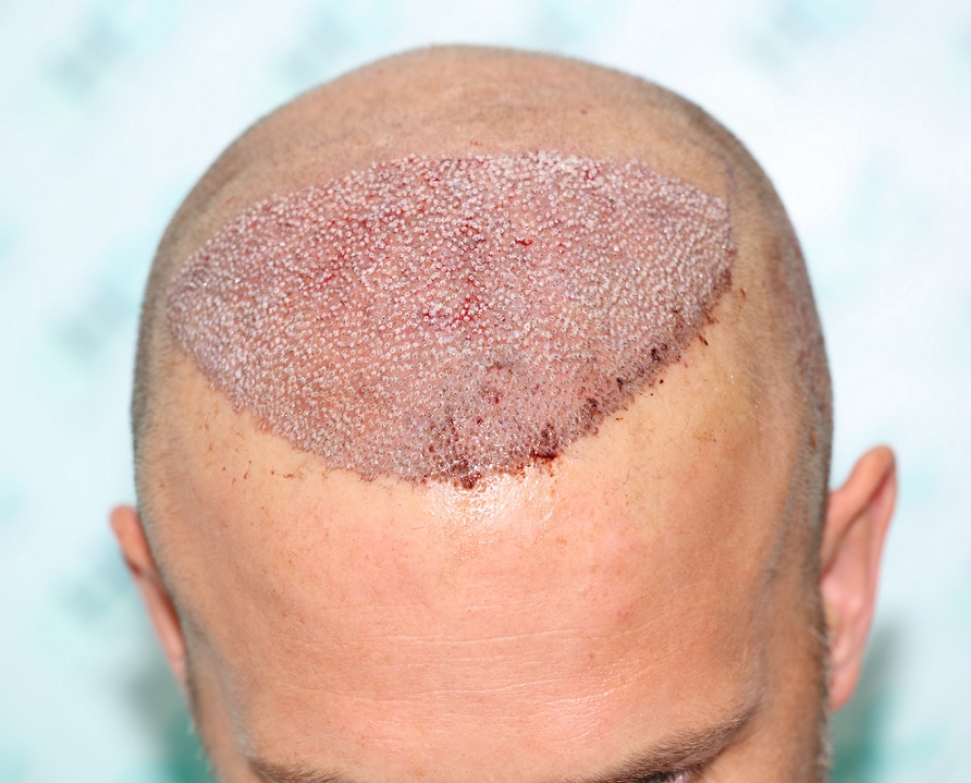 7. Post op 3400 grafts for FUE1.JPG