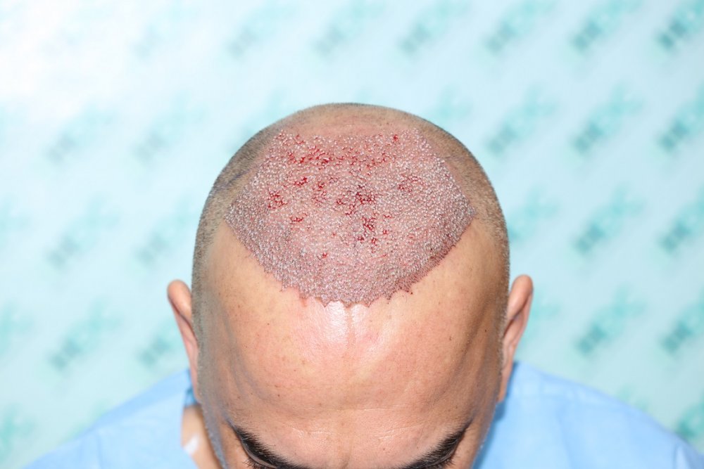 7. Post op Front top.JPG