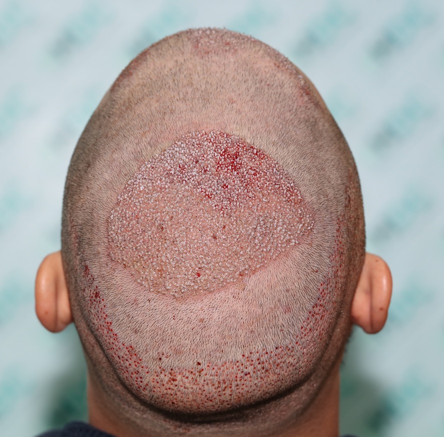 7. Post op FUE2 Recipient for 2700 Grafts- Crown.JPG