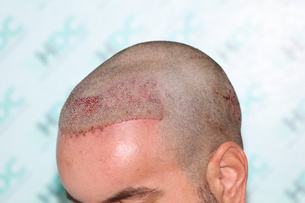 7. Post op  - Left.JPG